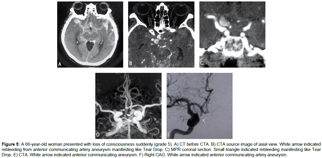 radiology-communicating-artery-aneurysm