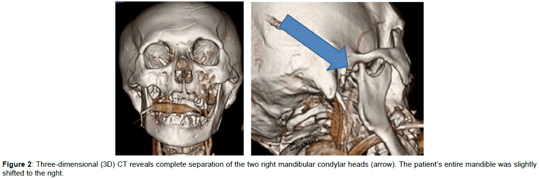 radiology-mandibular-condylar-heads