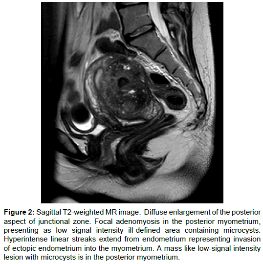 radiology-microcysts-posterior