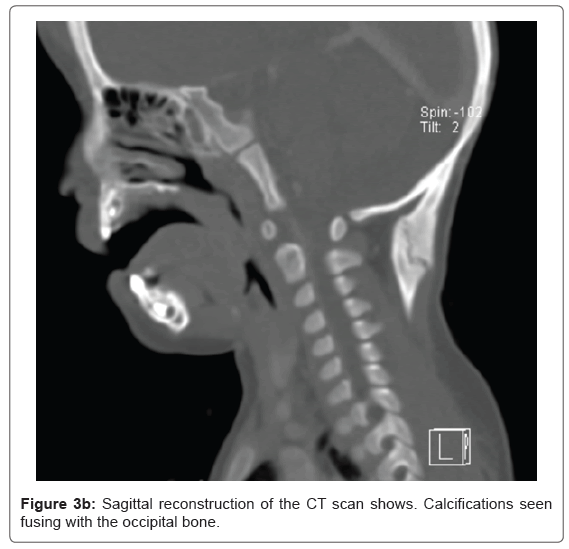 radiology-occipital-bone