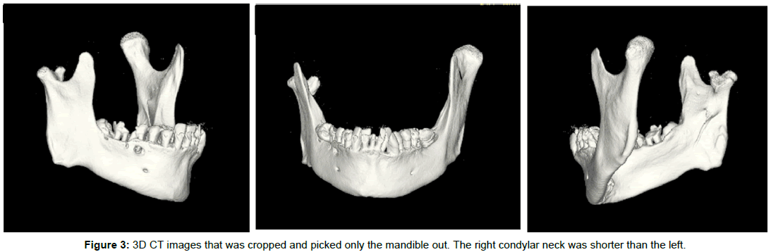 Quantitative Bone Spect Analysis Of Mandibular Condyles In An Asymptomatic Population