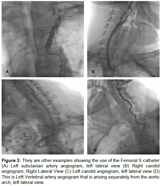 radiology-subclavian-artery-angiogram
