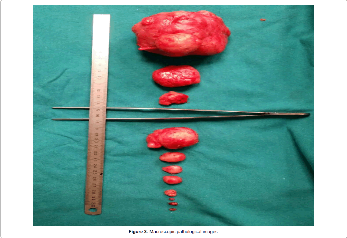 Fibroma of the vulva acupuncture pics 472