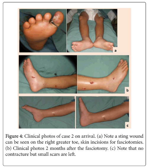 successful treatment of compartment syndrome following animal