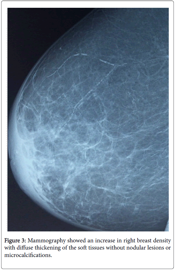tuberculosis-therapeutics-mammography-breast-density