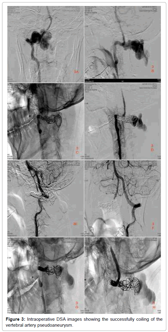 vascularmedicinesurgeryvertebralarterypseudoaneurysm